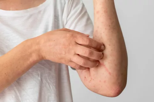 Réduire l'eczéma grâce à l'élimination de certains aliments